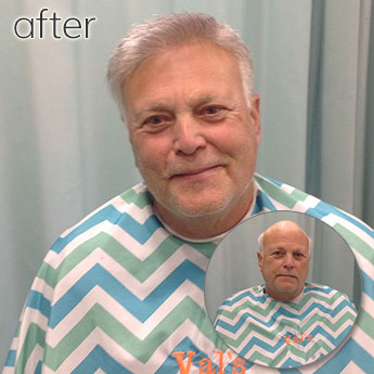 Before and After Image of Male Hair Replacement
