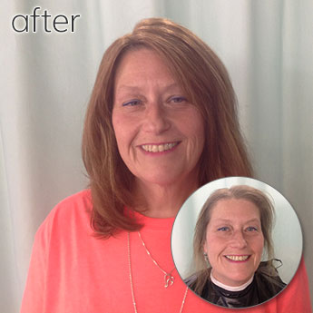 Before and After Image of Woman Hair Replacement